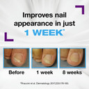 Emtrix® Fungal Nail Treatment Cream  Extra Strength Nail Fungus Penetrating Formula  Binds Moisture into the Nail  Softens Nourishes & Conditions  No Filing Needed