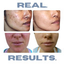 Clarifying Toner For Acne And Blemishes, Face Toner, Facial Toner, Skin Toner, Acne Toner, Toner Oily Skin, Salicylic Acid Toner, Astringent For Face, Toners, 4 Fl Oz