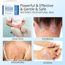 Jock Itch Antifungal Cream, Ringworm Treatment For Humans, Psoriasis Treatment, Psoriasis Scalp Treatment, Ringworm Cream For Humans, Foot & Body Balm, Provides Soothing Relief-100G