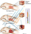 Burn Cream Skin Ointment Wound & Scar Care Fast First Aid Health Beauty Care (1 Tube = 15 Grams) ???? ????