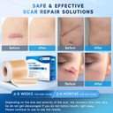 Silicone Scar Sheets, Silicone Scar Tape(1.6 X 120 Roll 3M), Silicone Scar Sheets For Surgical Scars, Keloid Bump Removal, Stretch Marks Removal, C-Section, Burn Et