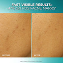 L'Oreal Paris Bright Reveal Dark Spot Exfoliant Peel, 25% Aha Bha Pha Face Exfoliator Solution, Gentle Skincare To Visibly Reduce Dark Spots And Renew Skin Texture, Includes Spf Lotion Sample