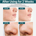 Md'S Pick La Plante Pdrn Hyaluronic Bioleedle Serum 1 Million Shots (Vegan Reedle, Hydrate & Reduce Wrinkles, Pore-Tightening, Hyaluronic Acid, Pdrn Serum, Korean Skin Care)