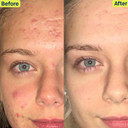Slmd Skincare By Dr. Pimple Popper - 30-Day Acne System - 4-Pc Kit - 3 Steps, 2X Per Day Full Routine To Treat And Prevent All Stages Of Acne Slmd Skincare By Dr. Pimple Popper - 30-Day Acne System - 4-Pc Kit - 3 Steps, 2X Per Day Full Routine To Treat And Prevent All Stages Of Acne