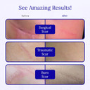 Rejuvaskin Rejuvasil Silicone Scar Gel, Scar Treatment For Surgical Scars, Burns, Keloids, Acne Scars On Face & Body, 0.33 Ounce
