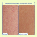 Skinfix Resurface+ Aha/Bha Renewing Cream: Exfoliating Body Cream That Visibly Smooths Rough, Bumpy & Crepey Skin While Moisturizing With Shea Butter, Jojoba Oil & Glycerin, 10 Fl Oz