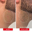 First Aid Beauty - Ingrown Hair Pads With Bha + Aha - Aftershave Treatment Pads To Help Prevent Razor Bumps For Men & Women - Exfoliate Underarms & Bikini Area - Compostable For Daily Use - 60 Pads