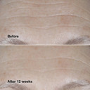 Clinique Smart Clinical Repair Broad Spectrum Spf 30 Wrinkle Correcting Cream With Peptides, Hyaluronic Acid + Glycerin | Protecting + Repairing