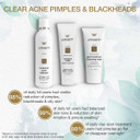 Lerosett Acne Kit Includes Cleanser Moisturizer & Spot Treatment Mask Organic Calming Aloe & Clay Based, Clears Acne, Pimples, Blackheads & Breakouts, Vegan Acne Kit, For All Skin Types