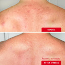 First Aid Beauty Body Acne Spray - Maximum Strength Body Acne Treatment With 360-Degree Sprayer - 2% Salicylic Acid Formula, (3.0 Oz)