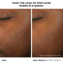 It Cosmetics Bye Bye Breakout Acne Treatment Face Serum -With 2% Salicylic Acid & 3% Lactic Acid - Helps Reduce Pimples In 3 Days & Fades Look Of Post-Acne Marks In 8 Weeks - 1 Fl. Oz