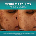 LOréal Paris Bright Reveal 12% [Niacinamide + Amino Sulfonic + Ferulic] Dark Spot Serum 1Oz + Moisturizer Sample