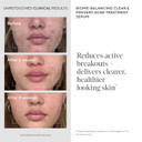 Murad Biome-Balancing Acne Treatment - Acne Facial Serum To Prevent Acne Breakouts With Salicylic Acid, Mandelic Acid, And Glutamic Acid For Balanced And Healthy Skin - 1.0 Fl Oz