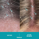 Ds Labs Dandrene Anti Dandruff Shampoo And Conditioner - Itchy & Dry Scalp Dandruff Treatment Shampoo Conditioner Set, Seborrheic Dermatitis Dandruff Scalp Treatment, Psoriasis Scalp Treatment