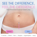 C Section Scar Silicone Strips For Surgical Scars, Tummy Tuck, C Section Recovery Must Haves - Silicone Scar Sheets - Large 7 Inch, 8 Reusable Strips
