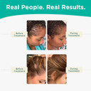 Shapiro Md Hair Growth Experts Women'S Regrowth Kit Plus: Shampoo, Conditioner, 2% Minoxidil, Leave-In Foamer. Anti Hair Loss And Thinning Hair Solution For Women, 1 Month