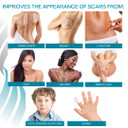Newgel+ Advanced Silicone Scar Treatment Sheeting For Old And New Scars, For Surgery, Injury, Keloids, C-Section, Burns, And Acne, Reusable, 1" X 6" Sheet (4 Count) - Beige
