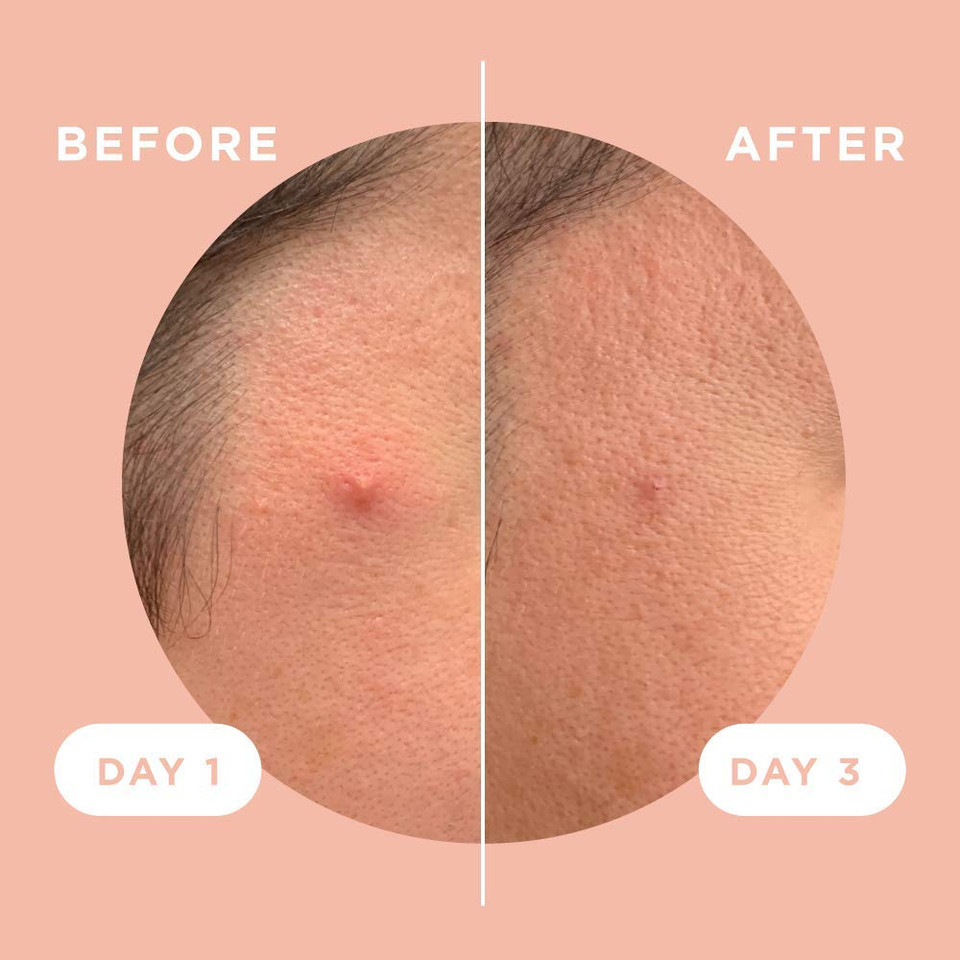 Zitsticka Beyond The Surface Bundle: Killa Microdart Acne Pimple Patches & Goo Getter Hydrocolloid Patch Bundle