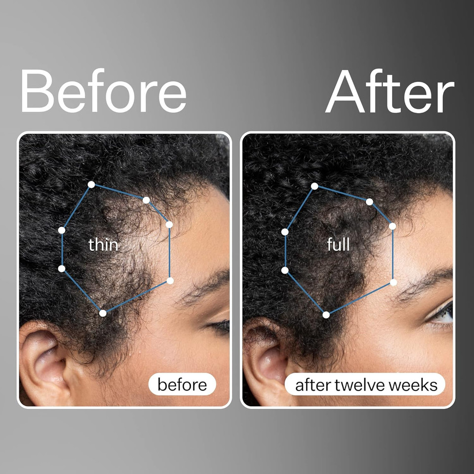 Act+Acre Cold Processed Apple Stem Cell Scalp Serum And Bha Salicylic Acid Scalp Exfoliator Bundle - Promotes Growth - Soothes And Hydrates - Itchy Scalp - Dry Scalp - Oily Hair