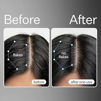 Act+Acre Cold Processed Apple Stem Cell Scalp Serum And Bha Salicylic Acid Scalp Exfoliator Bundle - Promotes Growth - Soothes And Hydrates - Itchy Scalp - Dry Scalp - Oily Hair