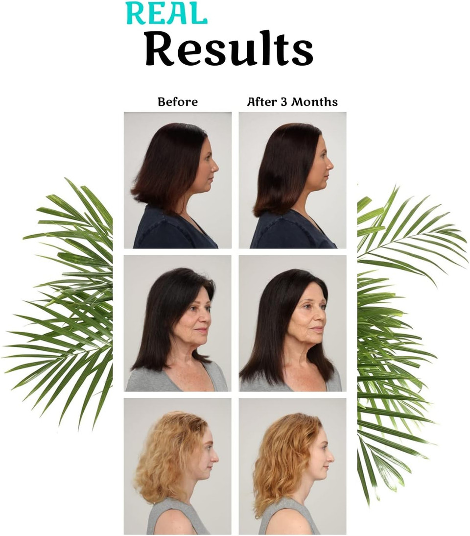 Hair La Vie Clinical Formula Hair Growth Vitamins For Women And Men With Biotin 5000Mcg, Collagen, And Saw Palmetto - Healthy Hair Growth Supplement Within Normal Ranges 90 Count (Pack Of 1)