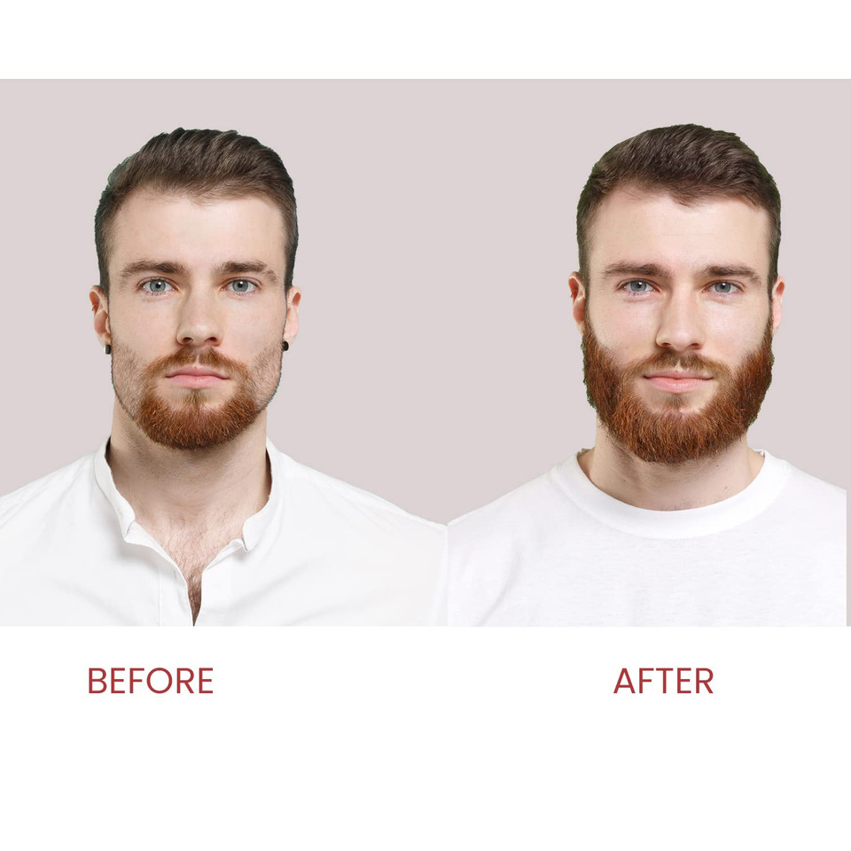 Biotin Hair Growth Shampoo For Men And Women - Treatment For Thinning Hair And Hair Loss - Biotin,Caffeine & Saw Palmetto Enriched Formula For Hair Thickening And Regrowth Dht Blocker 13.5 Floz