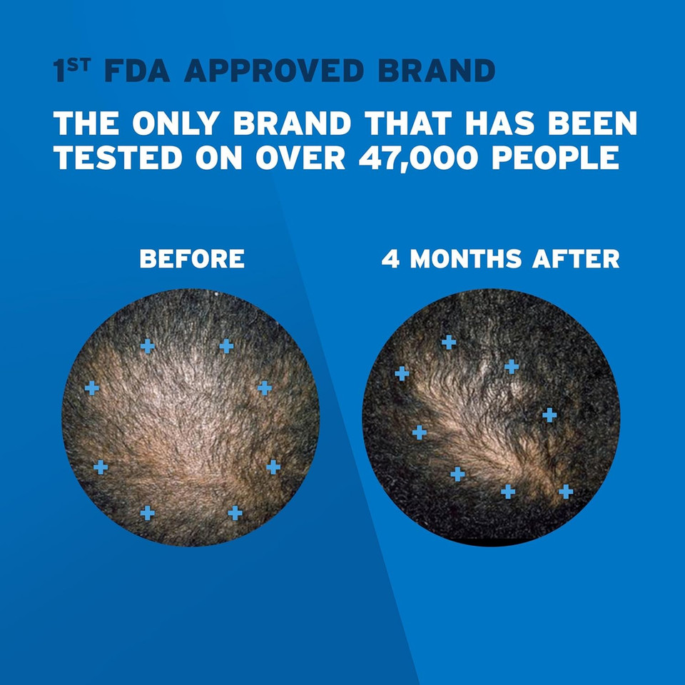 Menã¢ÂS Rogaine 5% Minoxidil Topical Foam, One Month Supply Menã¢ÂS Rogaine 5% Minoxidil Topical Foam, One Month Supply