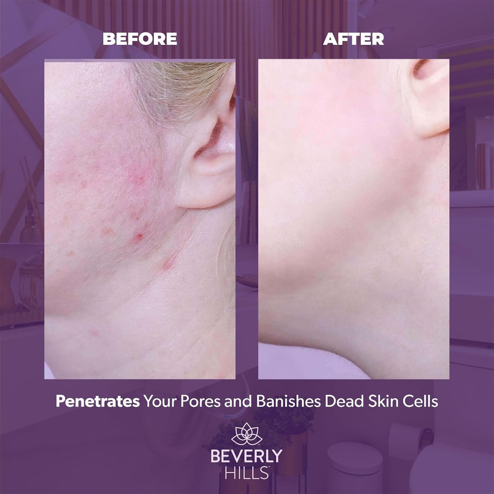 Beverly Hills Fruit Acid Peeling Pads - 50 Face Exfoliator Pads For Reducing Fine Lines & Dark Spots | Facial Cleansing Pads With Salicylic, Lactic & Mandelic Acid For Glowing Skin, 50 Face Pads Beverly Hills Fruit Acid Peeling Pads - 50 Face Exfoliator Pads For Reducing Fine Lines & Dark Spots | Facial Cleansing Pads With Salicylic, Lactic & Mandelic Acid For Glowing Skin, 50 Face Pads