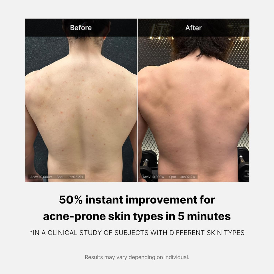 Medicube Red Acne Body Wash 14.52 Fl.Oz I Low Ph And Hydrating Cleanser With Salicylic Acid, Lactic Acid, Niacinamide And Hyaluronic Acid Suitable For Bacne Treatment | Korean Skin Care