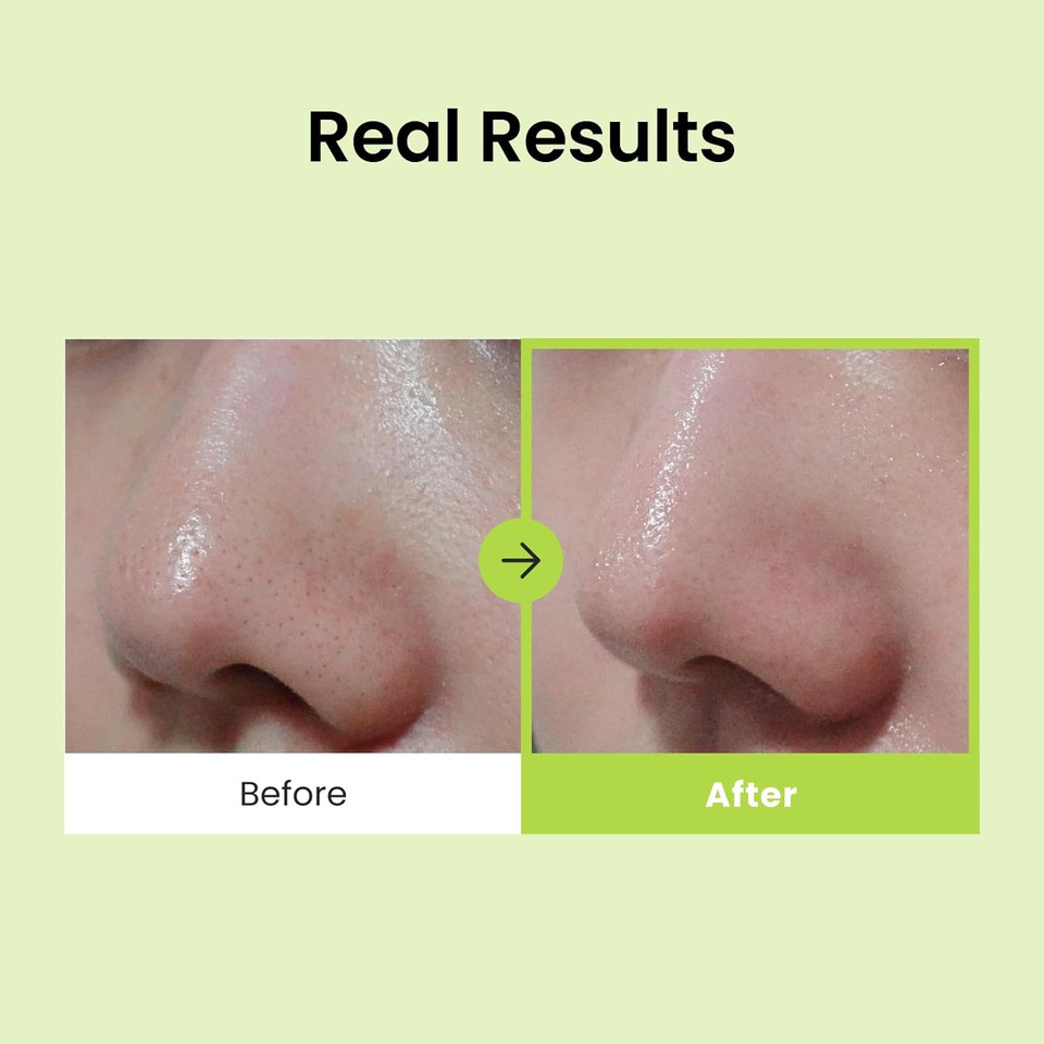 Cnp Anti-Pore Black Head Clear Kit - Hypoallergenic 2 Step Nose Pack, Pore Tightening With Witch Hazel Extract, Soothing, Clinically Tested, 10 Counts