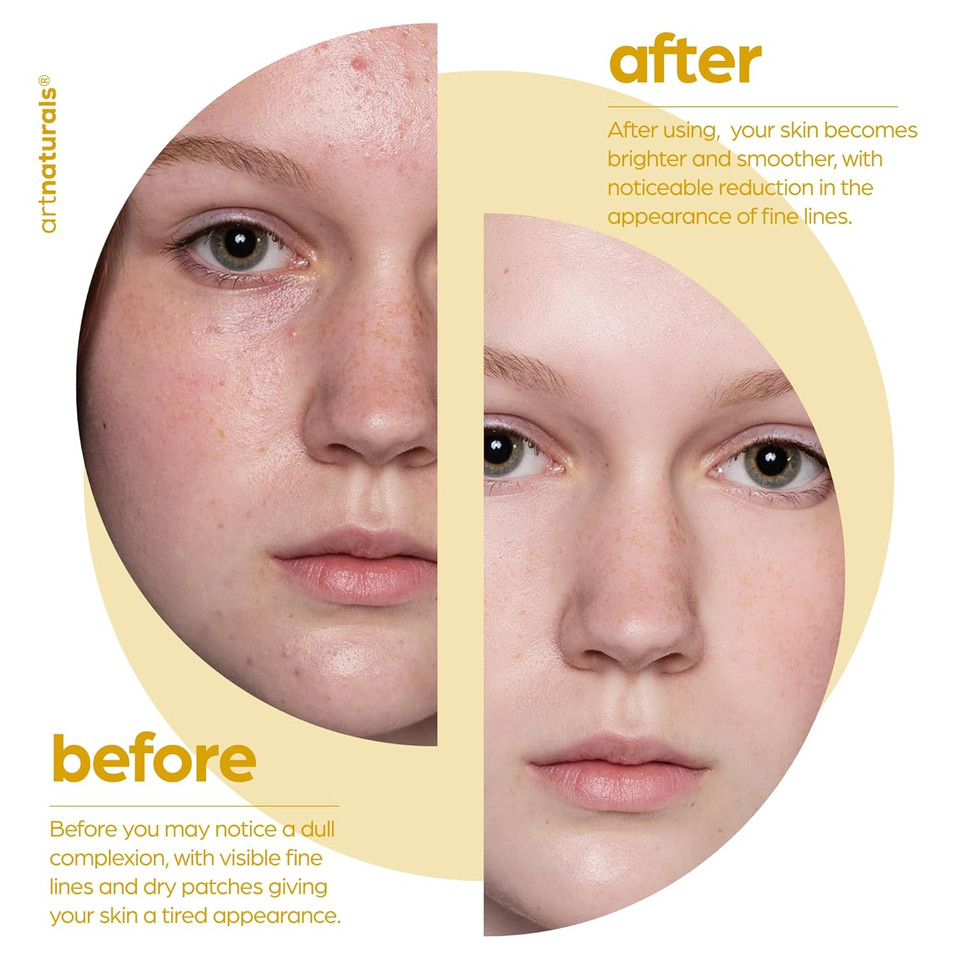 Artnaturals Lactic Acid Plus Aha Face Serum For Brightening Boost With Renewing Formula - Scars, Acne, Wrinkles - Exfoliates And Moisturizes The Skin - 1 Oz