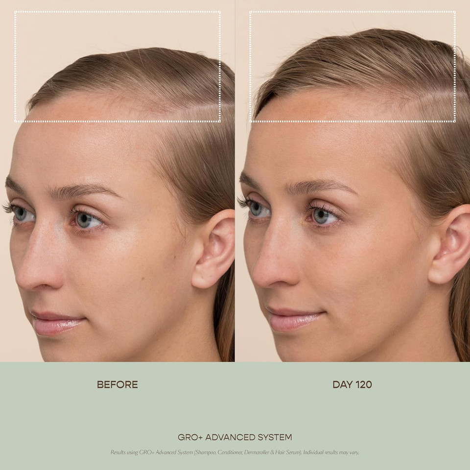 Vegamour Gro+ Advanced Balancing Shampoo | Lightly Exfoliates, Cleanses And Removes Buildup Without Stripping | For Severe Signs Of Thinning | Color Safe, Vegan, Cruelty-Free (8 Fl Oz)