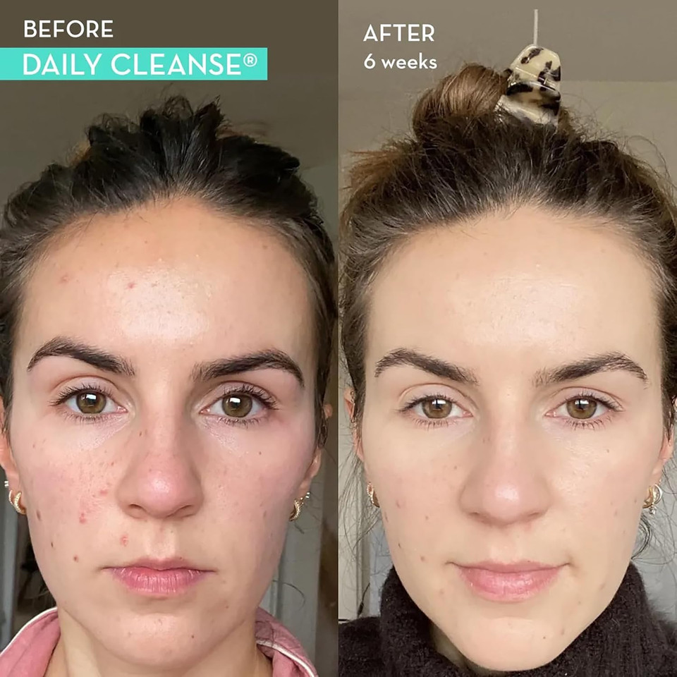 Hum Daily Cleanse Acne Supplement - Gut Cleanse Detox For Clear Skin With Organic Algae, Detoxifying Herbs, Zinc & Spirulina | Clear Skin Supplement (60 Capsules)