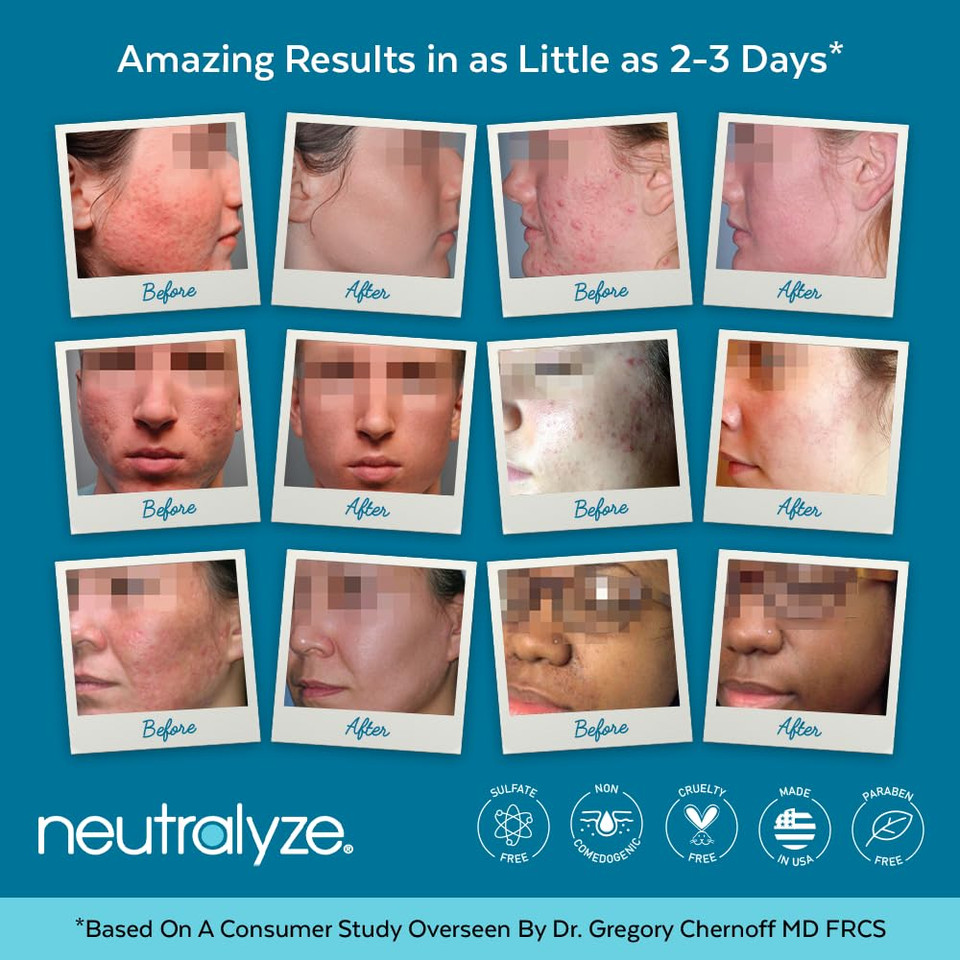 Exfoliating Acne Wipes - Maximum Strength, Dual Textured Acne Pads For Face & Back - Medical Grade 2% Mandelic Acid & Salicylic Acid Wipes - Acne Cleansing Pads (100 Acne Face Wipes)