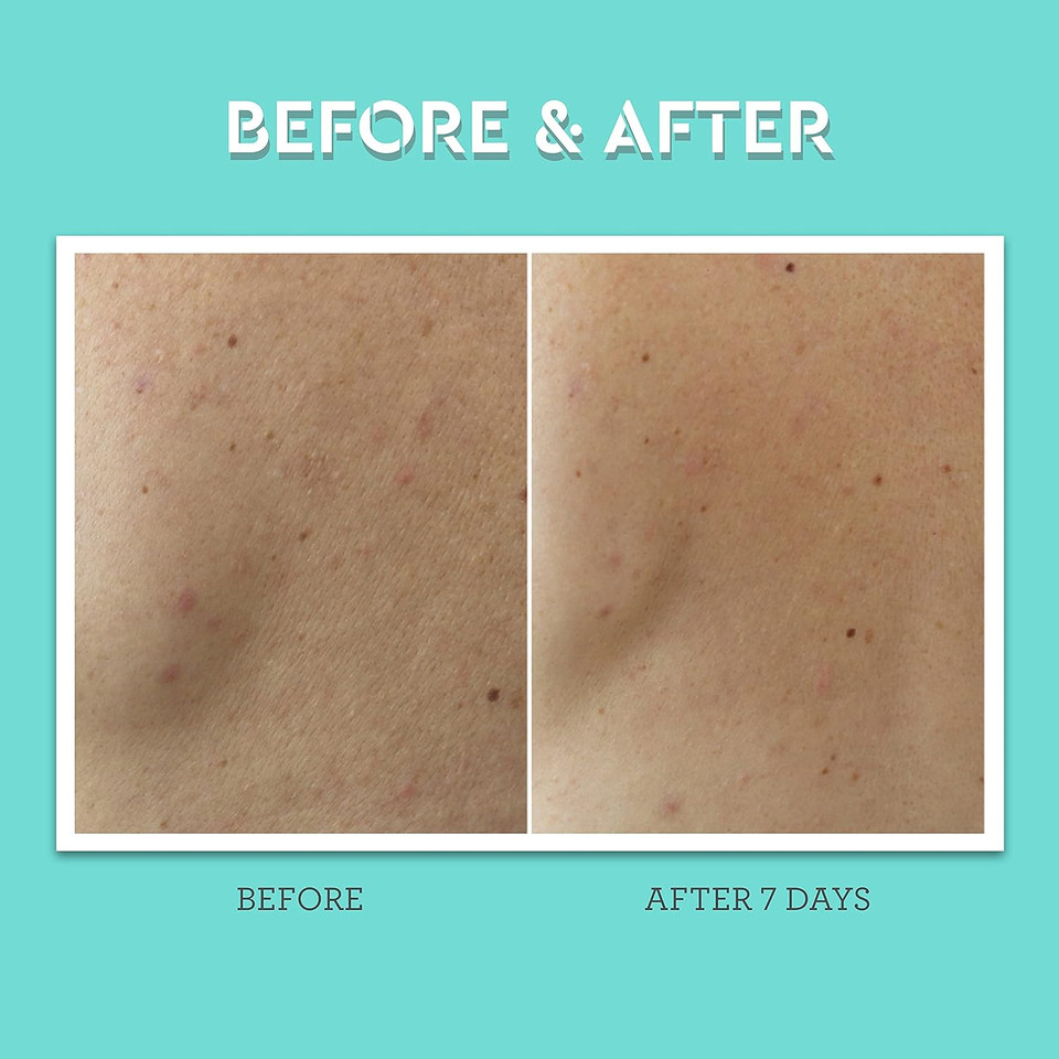 Bliss Clear Genius Body Acne Spray - 3.5 Fl Oz - Maximum Strength 2% Salicylic Acid & Niacinamide - Targets Body Acne & Prevents Future Breakouts - Post Workout - Clean - Vegan & Cruelty-Free