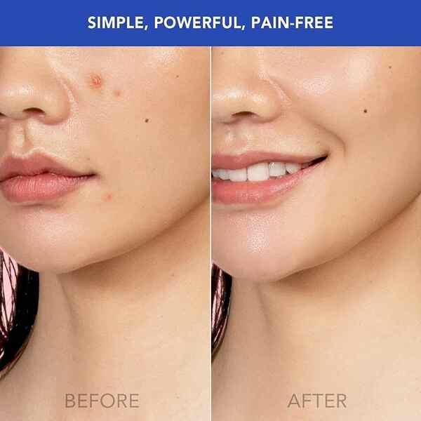 Foreo Espada Pro-Level Acne Treatment Device, Cobalt Blue