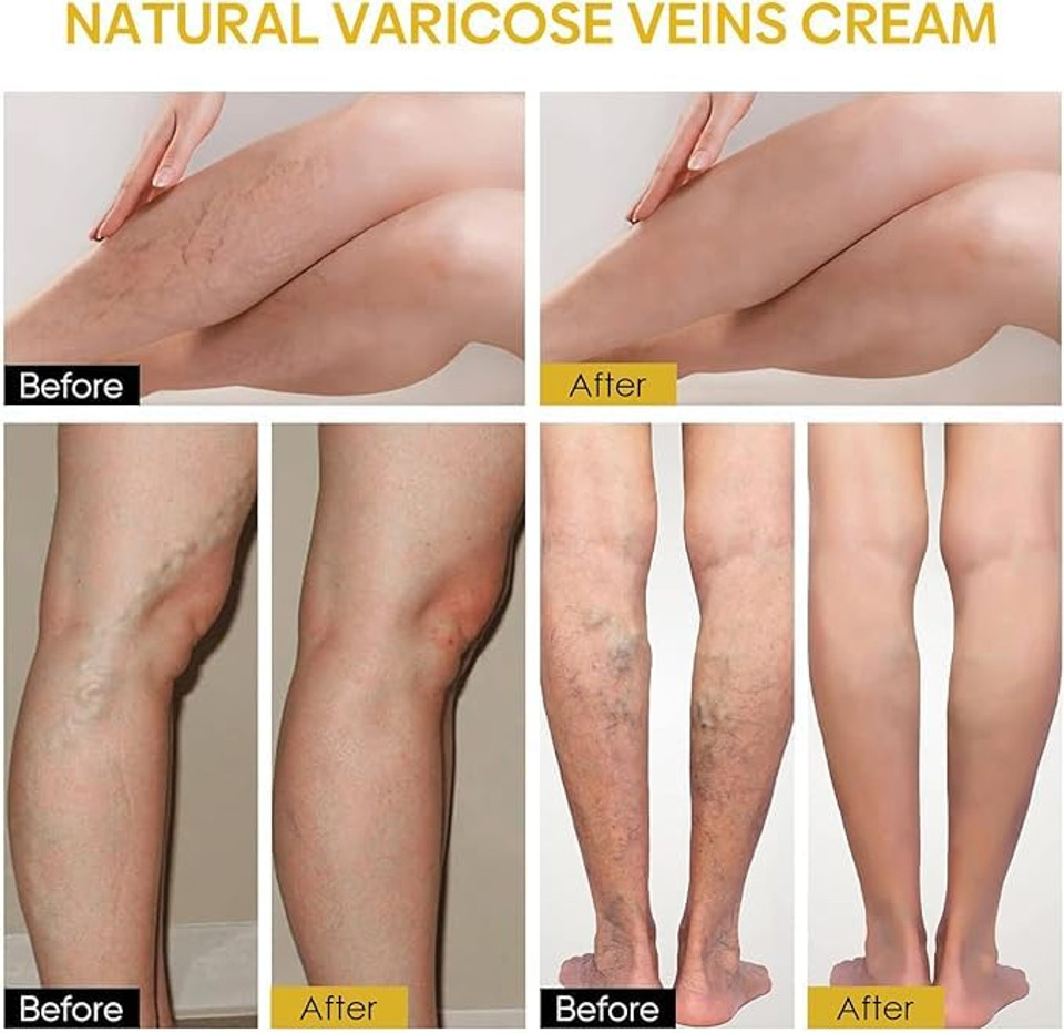 Bee Venom Varicose Veins Cream – Furzero Natural Pain Relief Ointment for Legs, Soothing & Healing Formula for Spider Veins, Swelling, and Psoriasis (60g)
