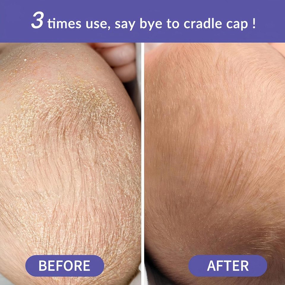 Bee Nature - Organic Baby Shampoo - Cradle Cap Treatment - Tear-Free - 99.3% Natural - Honey Mousse - Suitable for Newborns Toddlers Kids with Dry, Sensitive, Prone-Eczema, Itchy Scalp - 200ml