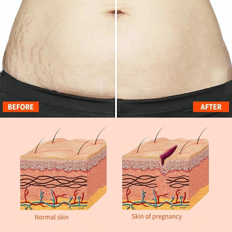 Stretch-Marks, Scar Treatment Oil - Boosts Collagen for Skin Lifting - Improves Treat of Scars, Stretch-Marks & Uneven Skin Tone - 125ml Stretch-Marks, Scar Treatment Oil - Boosts Collagen for Skin Lifting - Improves Treat of Scars, Stretch-Marks & Uneven Skin Tone - 125ml