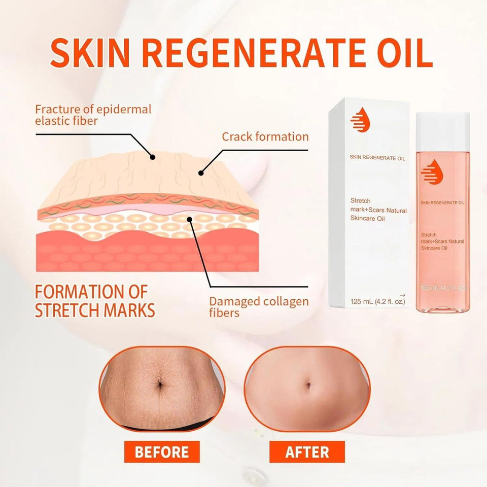 Stretch-Marks, Scar Treatment Oil - Boosts Collagen for Skin Lifting - Improves Treat of Scars, Stretch-Marks & Uneven Skin Tone - 125ml Stretch-Marks, Scar Treatment Oil - Boosts Collagen for Skin Lifting - Improves Treat of Scars, Stretch-Marks & Uneven Skin Tone - 125ml
