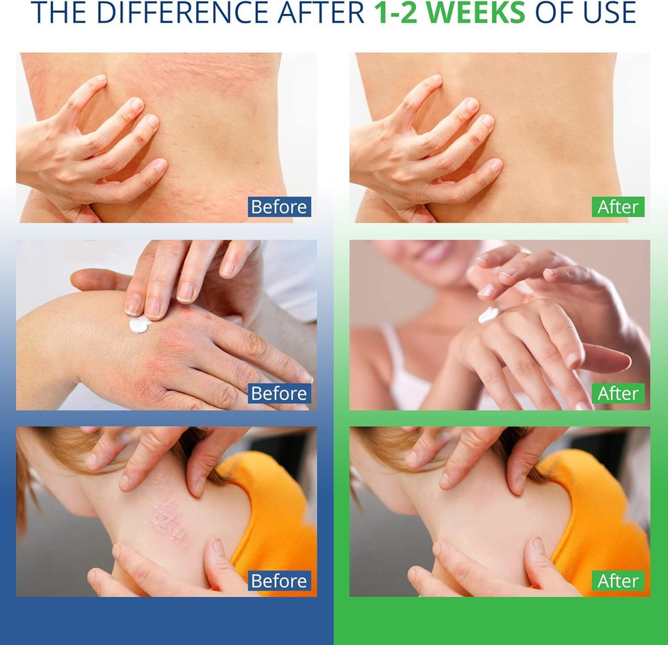 Effective 2% Anti Fungal Soap | Treats Intensive Fungal Infections of The Skin | Ringworm, Jock Itch, Dry Skin, Dandruff, Acne | 75g