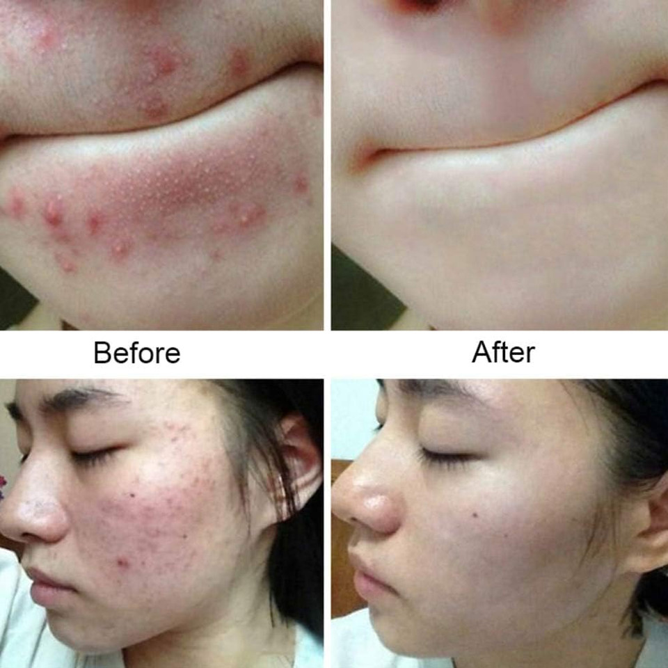 Effective 2% Anti Fungal Soap | Treats Intensive Fungal Infections of The Skin | Ringworm, Jock Itch, Dry Skin, Dandruff, Acne | 75g