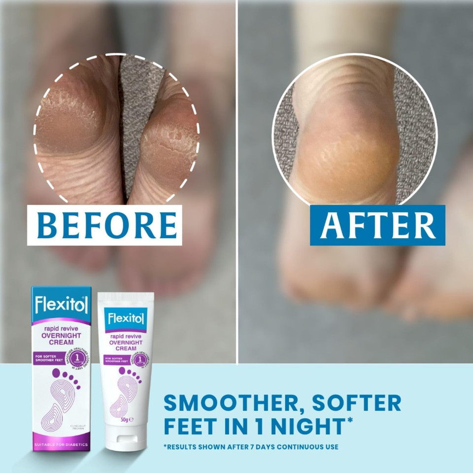 Flexitol Rapid Revive Overnight Foot Cream - 30 Percent Urea for Extremely Dry, Hard, Rough Skin on Feet - Results in 1 Night - Clinically Proven Foot Care - High Urea - Suitable for Diabetics. 50g Flexitol Rapid Revive Overnight Foot Cream - 30 Percent Urea for Extremely Dry, Hard, Rough Skin on Feet - Results in 1 Night - Clinically Proven Foot Care - High Urea - Suitable for Diabetics. 50g