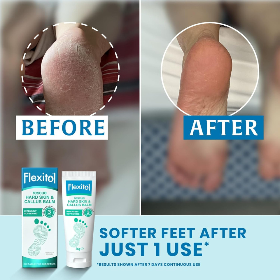 Flexitol Rescue Hard Skin and Callus Balm - Foot Cream for Visible Results in 3 Days - Exfoliates Dry, Hard Feet - Clinically Proven to Soften Feet - 22 Percent Urea - Suitable for Diabetics. 56g Flexitol Rescue Hard Skin and Callus Balm - Foot Cream for Visible Results in 3 Days - Exfoliates Dry, Hard Feet - Clinically Proven to Soften Feet - 22 Percent Urea - Suitable for Diabetics. 56g