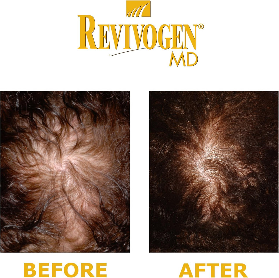 REVIVOGEN MD Scalp Therapy. Natural Hair Loss Solution for Fine & Thinning Hair