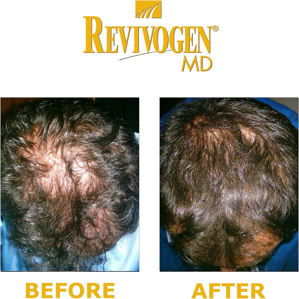 REVIVOGEN MD Scalp Therapy. Natural Hair Loss Solution for Fine & Thinning Hair