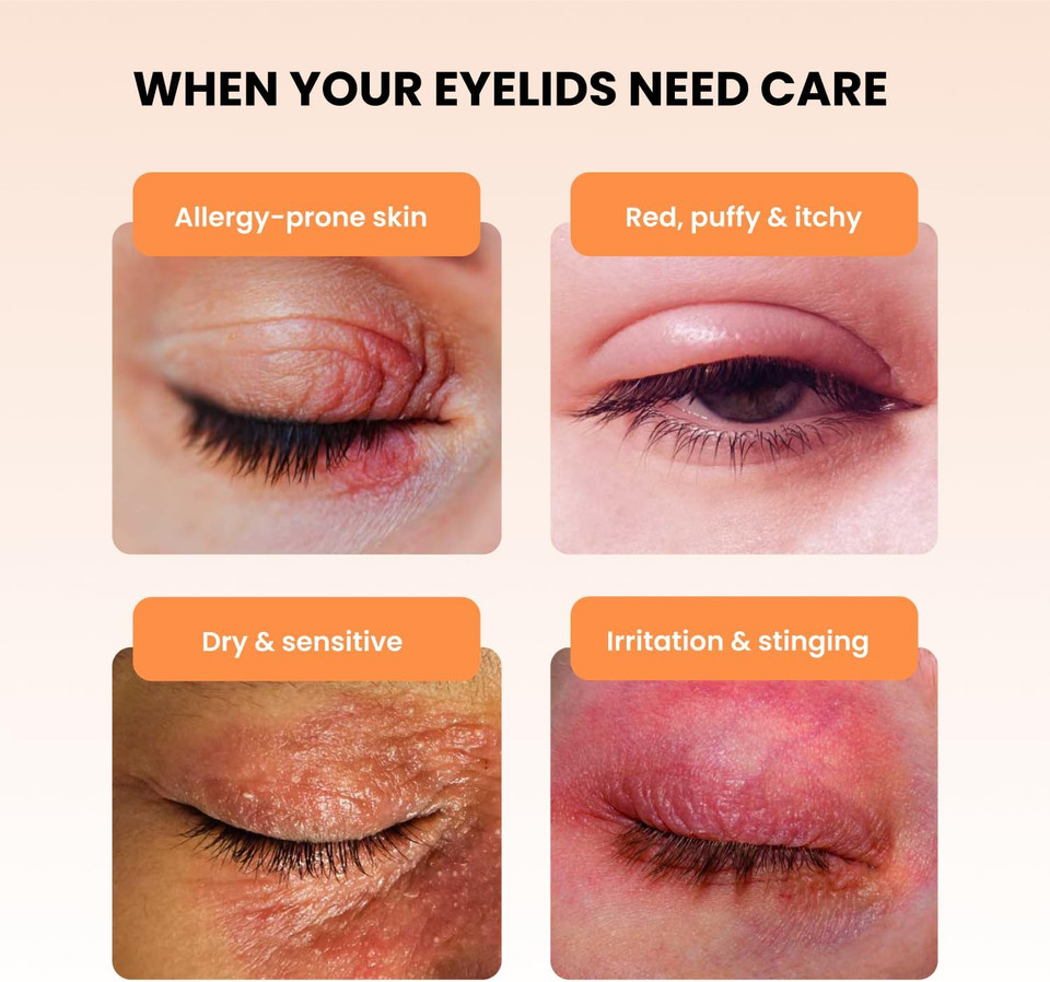 BLEPHADERM® Soothing Eyelid and Eye Contour Cream - Soothes, Protects, Repairs, Moisturises And Reduces Puffiness - for sensitive, dry, irritated, skin around the eye area. 40ml