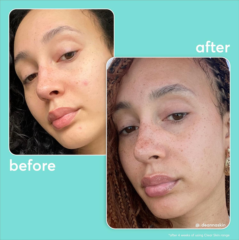 Super Facialist On The Spot Clarifying Gel - Spot Treatment for Acne with 10% Niacinamide, Tea Tree Oil & Prebiotics, Vegan Friendly 15ml