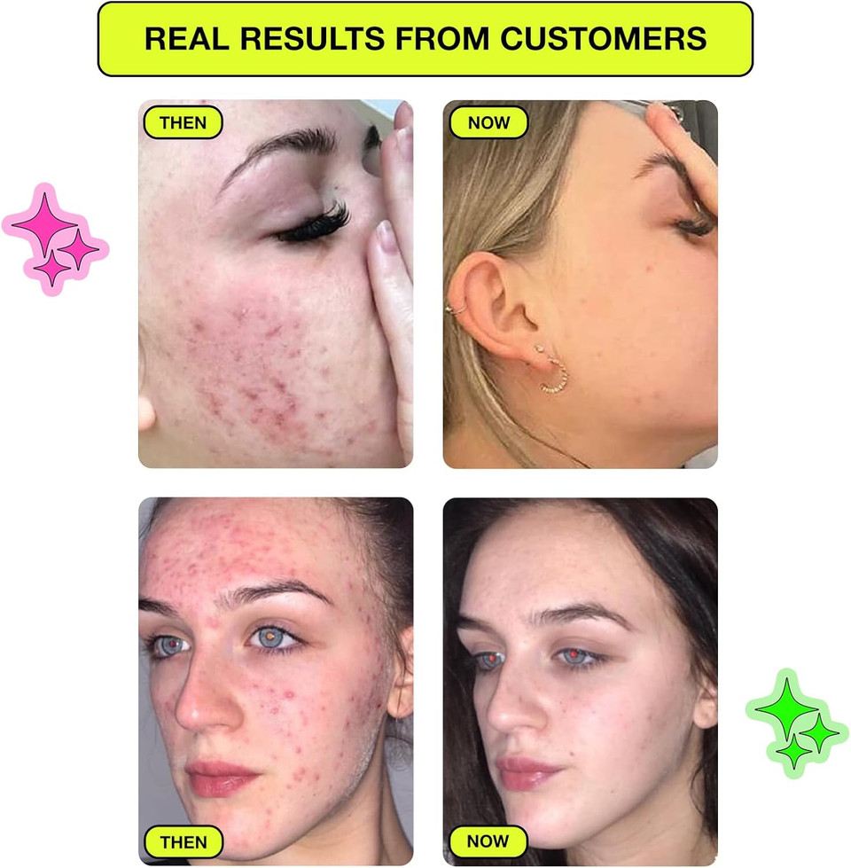 Carbon Theory Supacylic Face Serum - Serum - Targets Blemishes, Dry Skin - Spot Treatment & Blemish Treatment - Vegan Facial Exfoliator Serum - 30ml