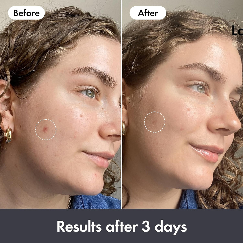 Hero Cosmetics Rescue Balm Post-Blemish Recovery Cream, Nourishing and Hydrating Moisturiser for Acne Prone Skin to Improve Skin Look, Dermatologist-Tested, Suitable for Sensitive Skin, 15 ml